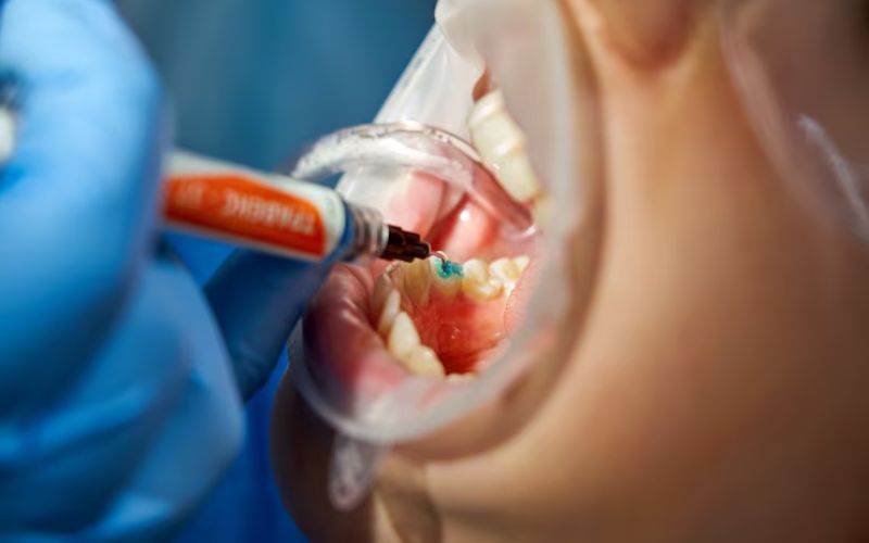 teeth cleaning in gurgaon